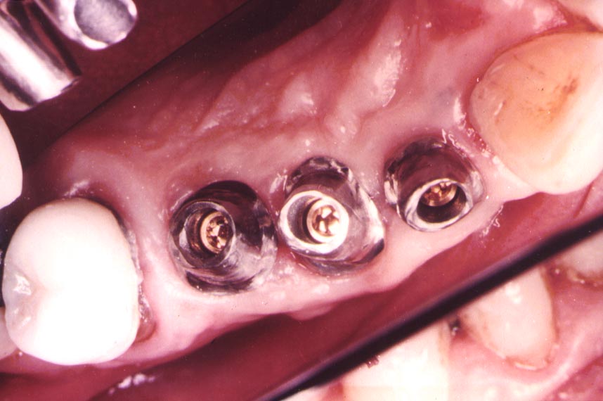 Implantes colocados en boca