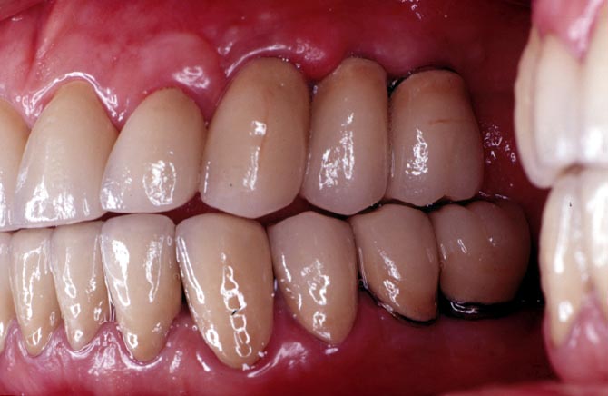Frula de porcelana superior e inferior puesta sobre implantes terminada en boca